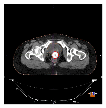 Cervical Brachytherapy: Staging, Target Delineation & Dose Constraints